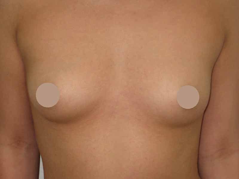 Breast augmentation240cc_2_takee_20100403