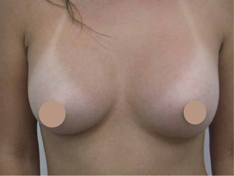 Breast augmentation240cc_3_takee_20100403