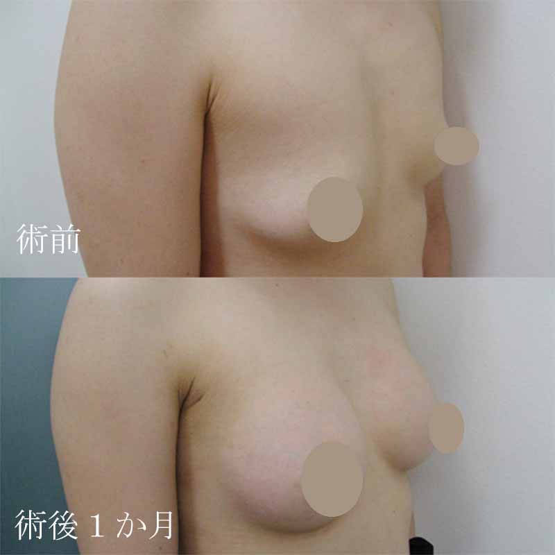 Breast augmentation_1_20100404_220ccMM