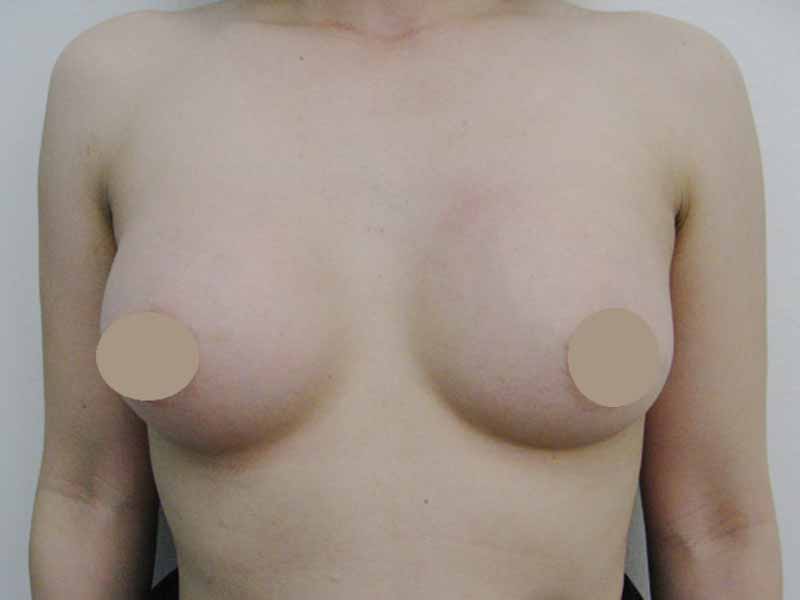 Breast augmentation_3_20100404_220cc術後１ヶ月目