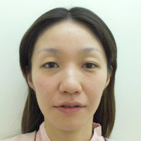 耳介軟骨移植の症例一覧 ランキング 美容整形 美容外科なら水の森美容外科 公式 総合サイト