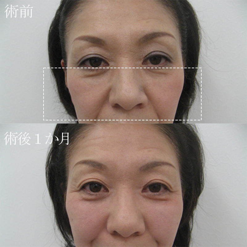 中顔面のヒアルロン酸注入_2010.4.2_竹江png