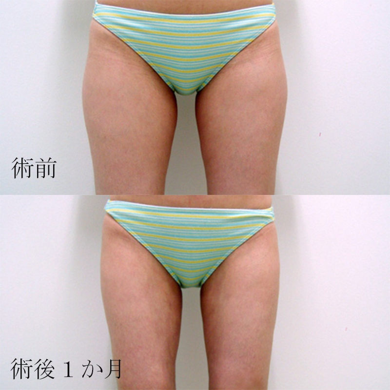太腿の脂肪吸引_2010.4.6_竹江