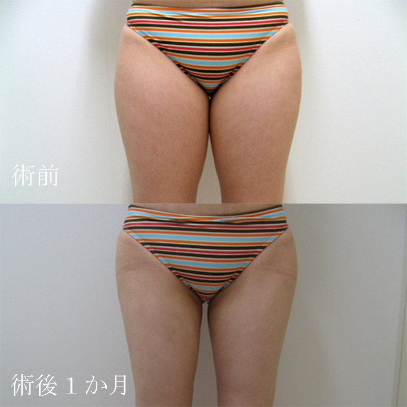 太腿の脂肪吸引_2010.4.7_竹江