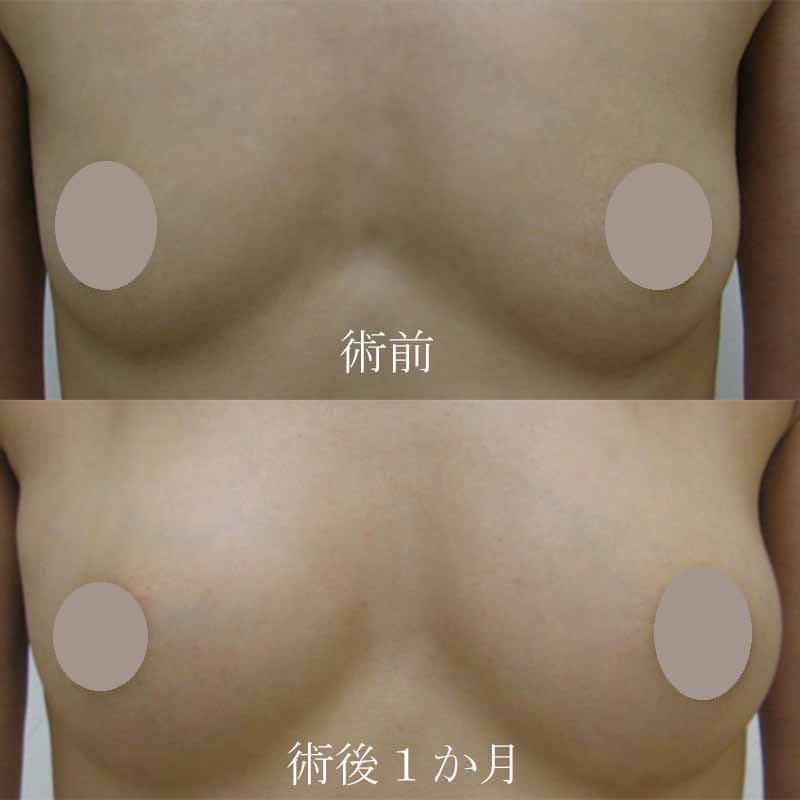 Breast augmentation_1_takee_20100525
