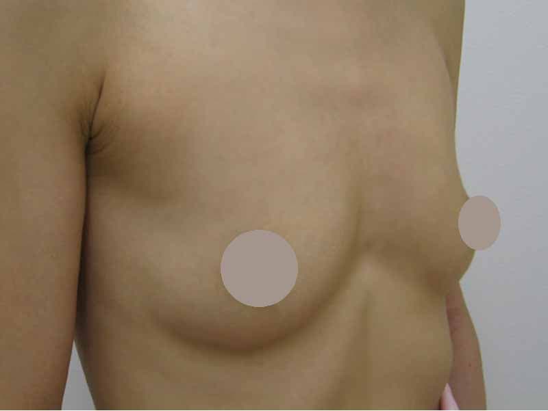 Breast augmentation220cc_2_takee_20100525