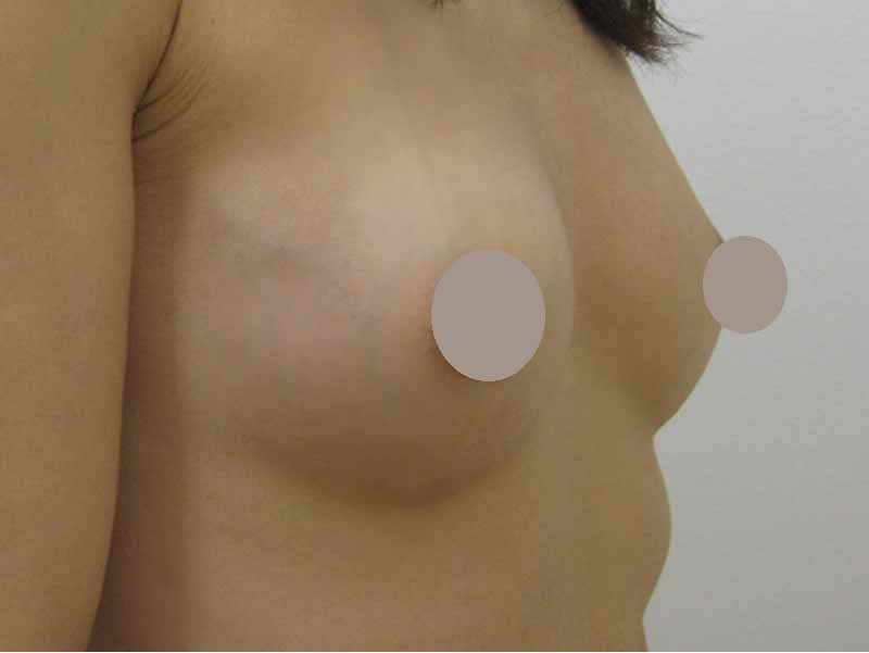 Breast augmentation220cc_3_takee_20100525