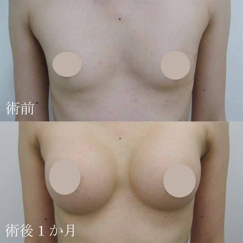 Breast augmentation_1_20100622_200ccMM