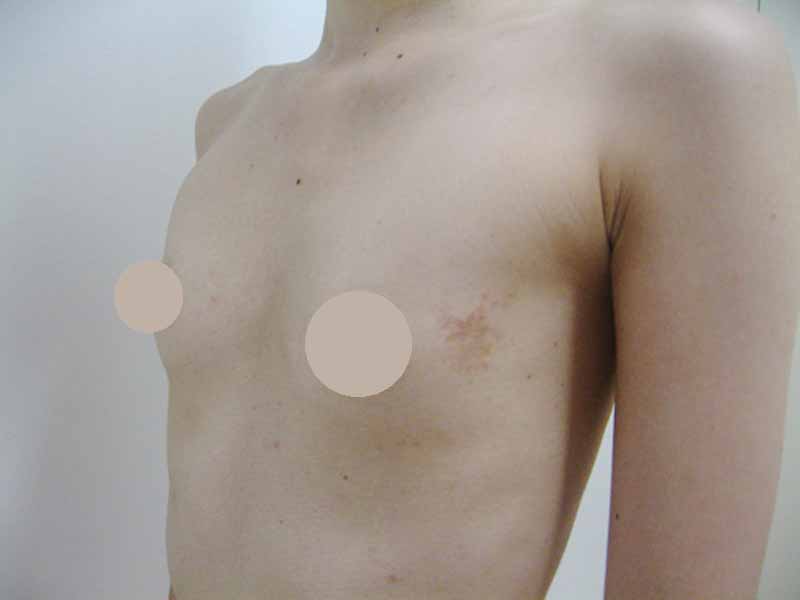 Breast augmentation_2_20100622_200cc施術前