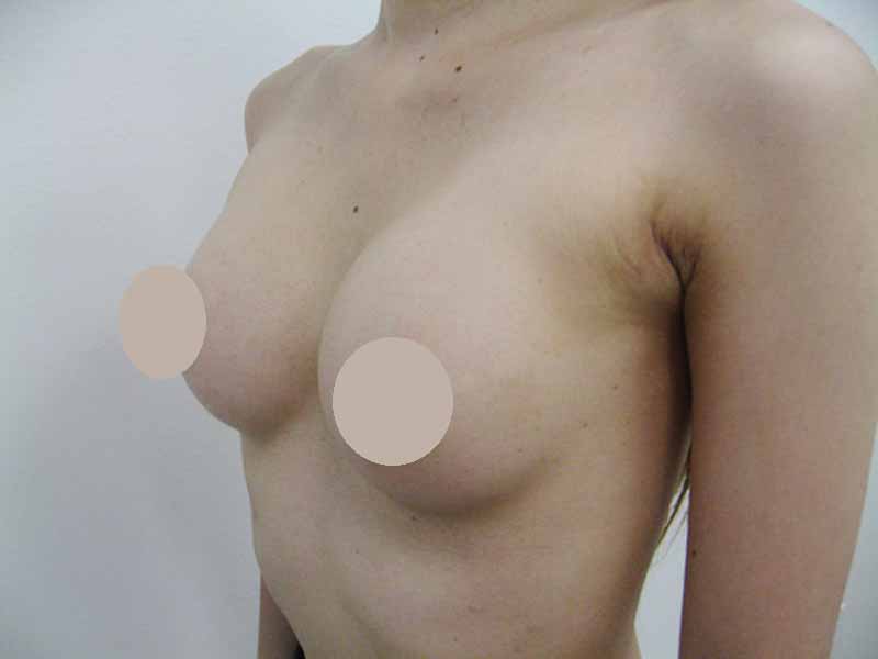Breast augmentation_3_20100622_200cc術後１ヶ月目