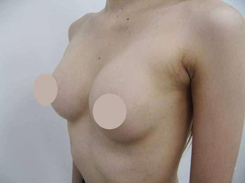 Breast augmentation_3_20100622_200cc術後１ヶ月目