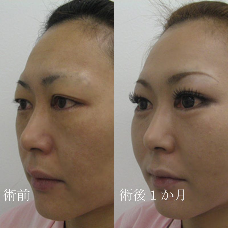 ナチュラルファイバー（頬＋中顔面）＋涙袋のヒアルロン酸_2010.6.4_竹江