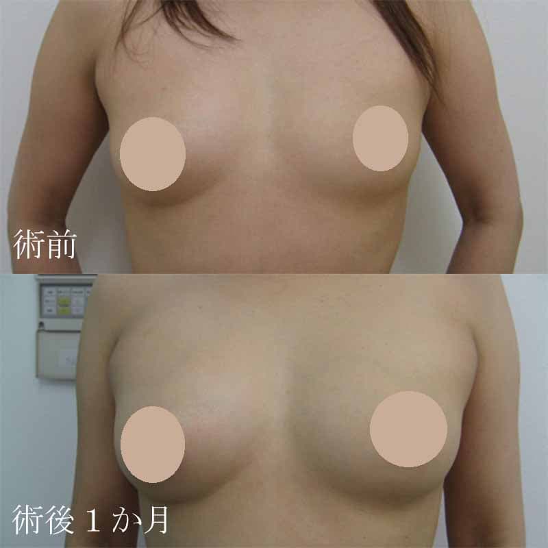 Breast augmentation_1_takee_20100709
