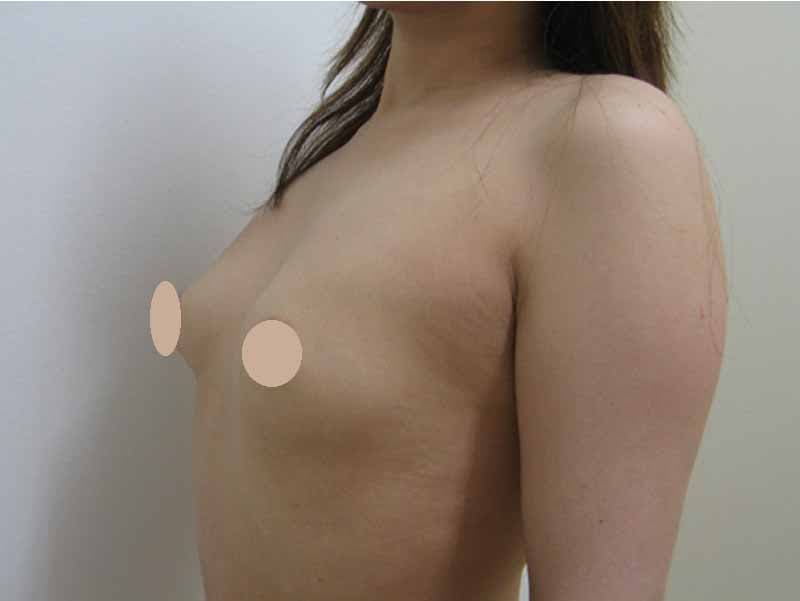 Breast augmentation_2_takee_20100709