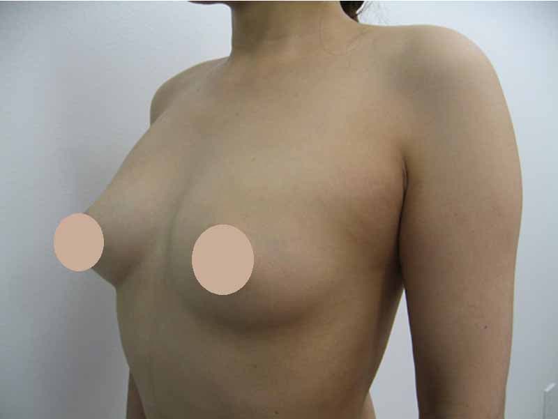 Breast augmentation_3_takee_20100709