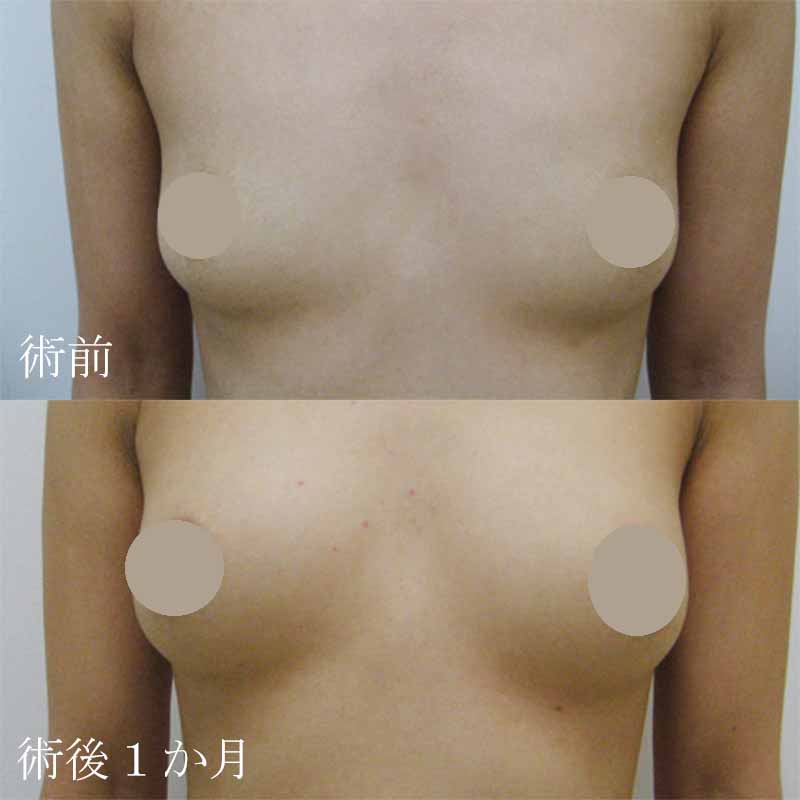 Breast augmentation_1_20100722MM