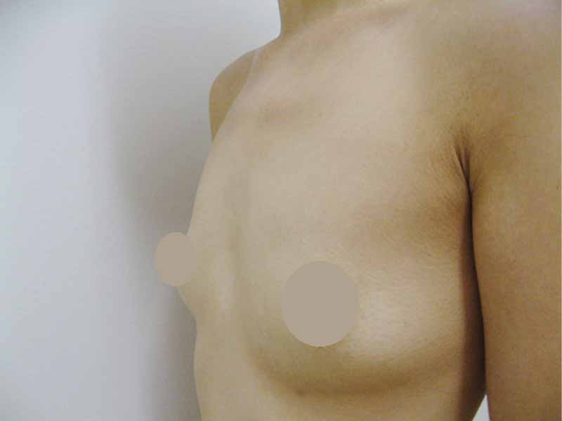 Breast augmentation_2_20100722施術前