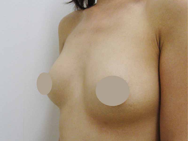 Breast augmentation_3_20100722術後１ヶ月目