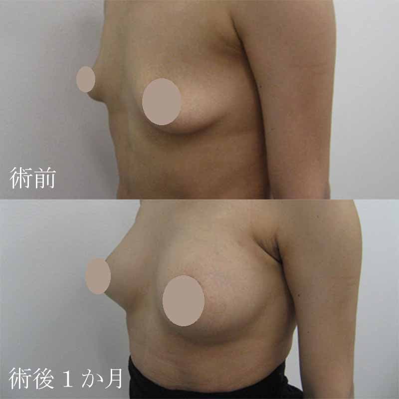 Breast augmentation220cc_1_takee_20100819