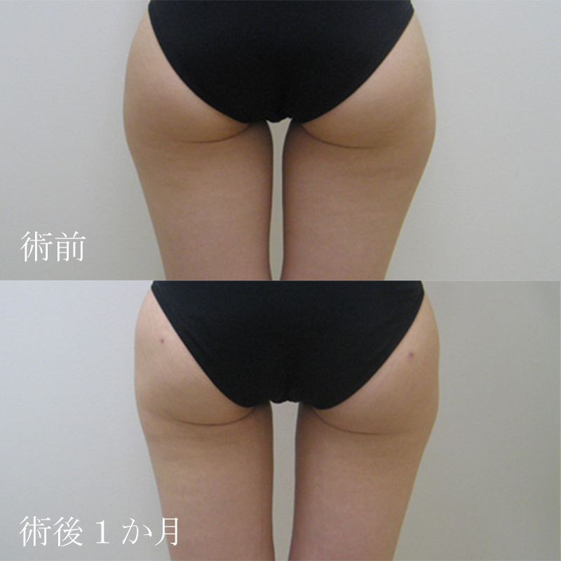 太腿の脂肪吸引_2011.2.2_竹江