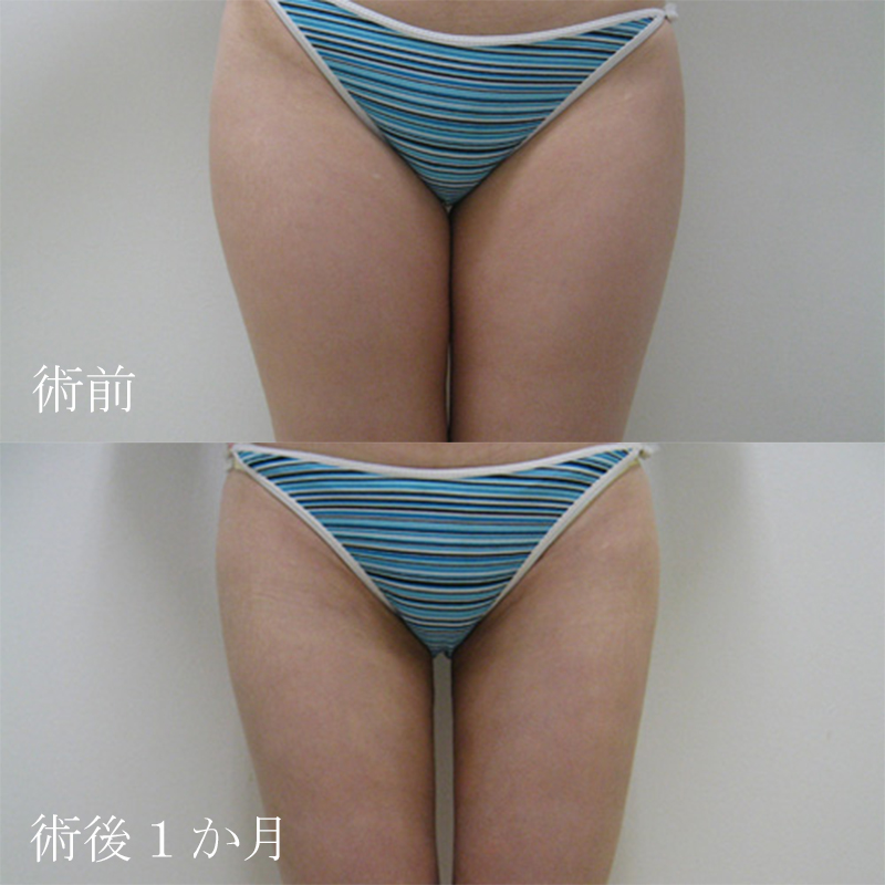 太腿の脂肪吸引_2011.3.9_竹江