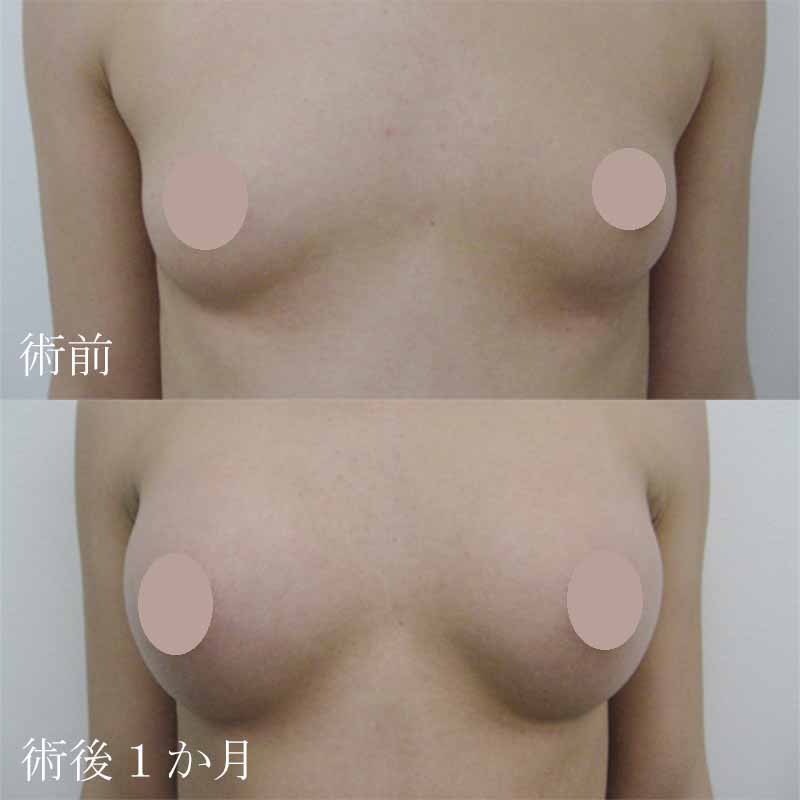 Breast augmentation_1_20110520_225ccMM