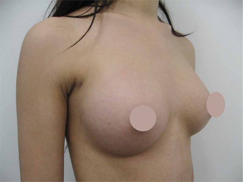 Breast augmentation_3_20110520_225cc術後１ヶ月目