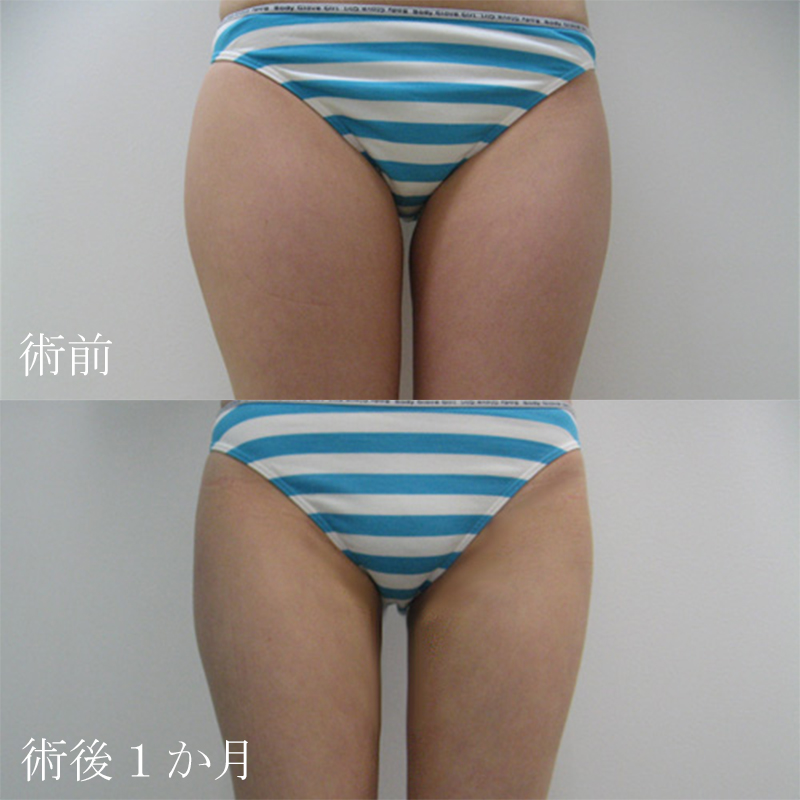 太腿の脂肪吸引_2011.5.16_竹江