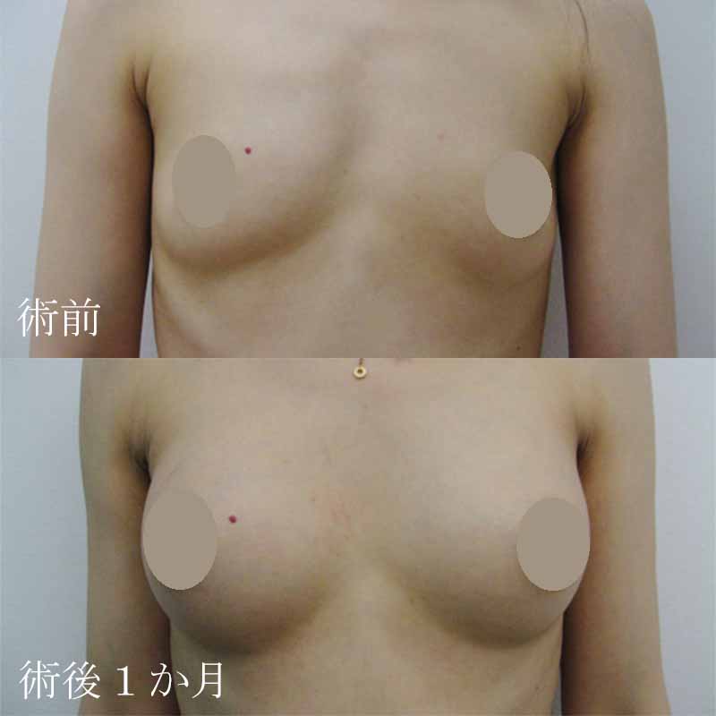 Breast augmentation_1_takee_20110606