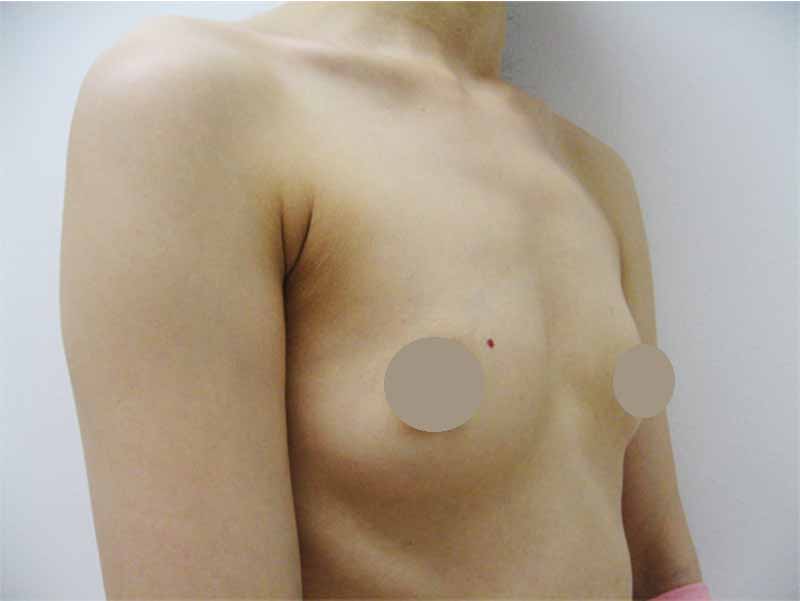 Breast augmentation_2_takee_20110606