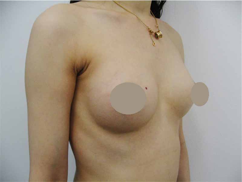 Breast augmentation_3_takee_20110606