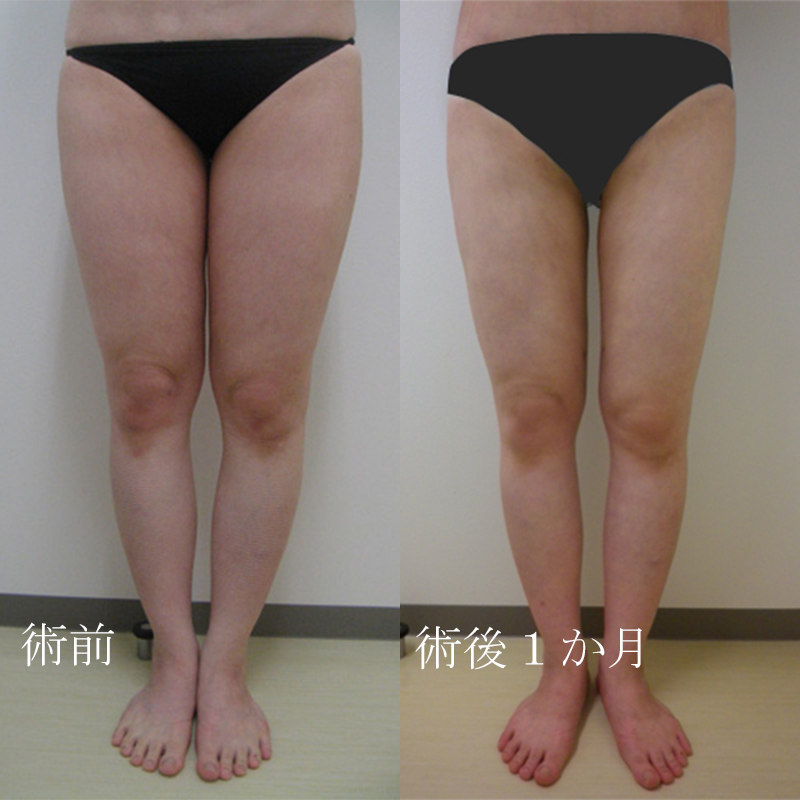 太腿の脂肪吸引_2011.6.29_竹江