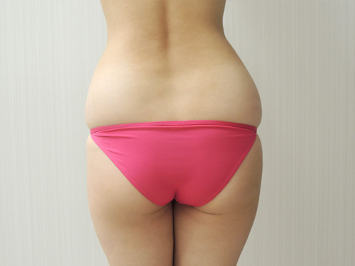 12年12月26日 脂肪吸引 太もも全周 臀部含む 症例写真 美容整形 美容外科なら水の森美容外科 公式 総合サイト 12年12月26日 脂肪吸引 太もも全周 臀部含む 症例写真 美容整形 美容外科なら水の森美容外科 公式 総合サイト