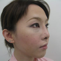 眼瞼下垂・鼻プロテーゼ術後写真