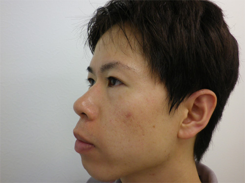 二重切開法・鼻プロテーゼ・小鼻縮小施術前横写真