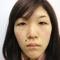 小顔 顎 唇の症例一覧 ランキング 美容整形なら水の森美容外科 公式 総合サイト