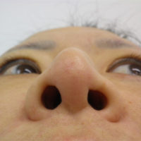 鼻プロテーゼ、鼻尖縮小、眼瞼下垂、ハムラー法、フェイスリフト術後下から写真