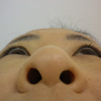 鼻プロテーゼ、鼻尖縮小、眼瞼下垂、ハムラー法、フェイスリフト術前下から写真
