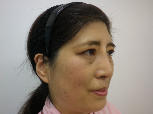 隆鼻術（鼻プロテーゼ）、二重切開法施術後斜め写真
