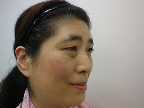 隆鼻術（鼻プロテーゼ）、二重切開法施術前斜め写真