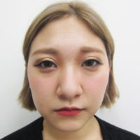 鼻尖縮小 だんご鼻修正 の症例一覧 ランキング 美容整形 美容外科なら水の森美容外科 公式 総合サイト