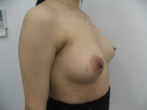 【豊胸術】乳腺下法（シリコン200cc）術後