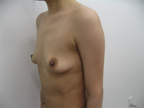 【豊胸術】乳腺下法（シリコン200cc）術前