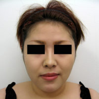 お顔の脂肪吸引、顎のプロテーゼ挿入術、お鼻のプロテーゼ施術後写真