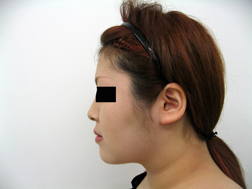お顔の脂肪吸引、顎のプロテーゼ挿入術、お鼻のプロテーゼ施術後横写真