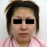 お顔の脂肪吸引、顎のプロテーゼ挿入術、お鼻のプロテーゼ施術前写真