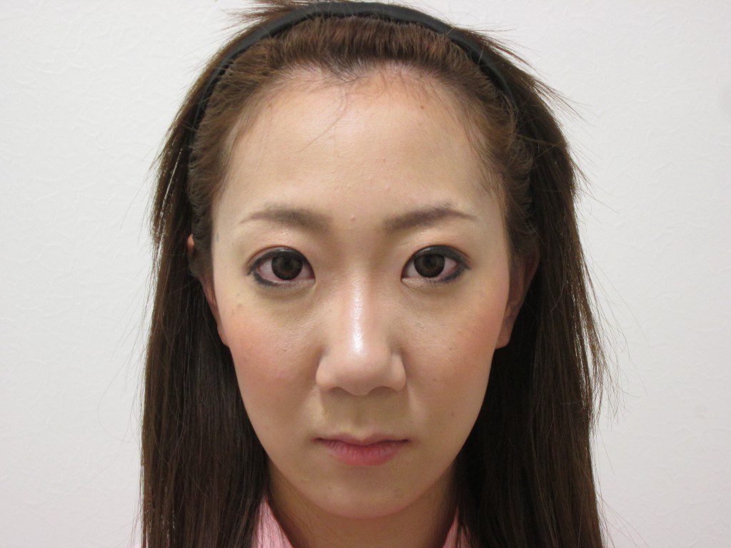 鼻プロテーゼ 鼻中隔延長 水の森美容外科 総合サイト 美容整形 美容外科クリニック 鼻プロテーゼ 鼻中隔延長 水の森美容外科 総合サイト 美容整形 美容外科クリニック