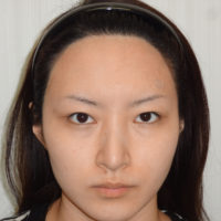 鼻骨骨切りの整形について 美容整形 美容外科なら水の森美容外科 公式 総合サイト