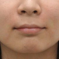 ほうれい線へのヒアルロン酸注入 美容整形なら水の森美容外科 ほうれい線へのヒアルロン酸注入 美容整形なら水の森美容外科