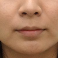 ほうれい線へのヒアルロン酸注入 注入認定医が在籍 美容整形 美容外科なら水の森美容外科 公式 総合サイト ほうれい線へのヒアルロン酸注入 注入認定医が在籍 美容整形 美容外科なら水の森美容外科 公式 総合サイト